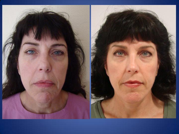 Témoignage de la chirurgie du visage Avant-Aprés Janette