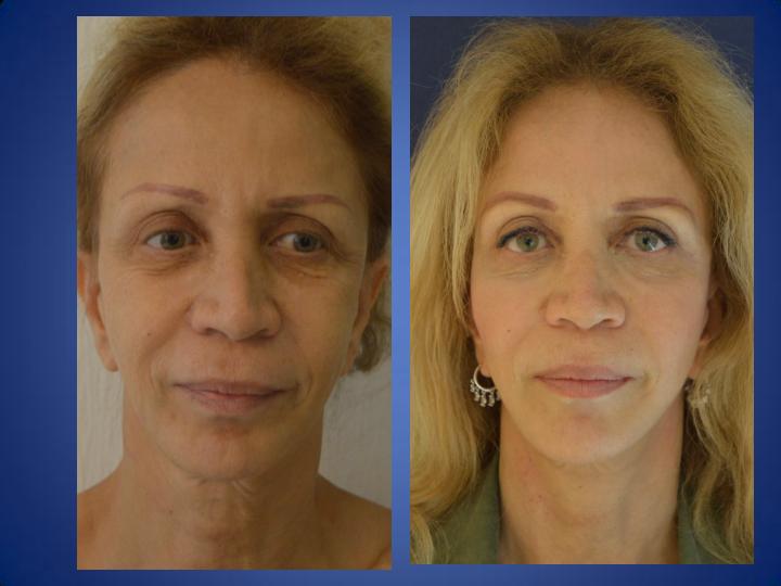 Témoignage de la Chirurgie du visage Avant-Aprrés front Lila