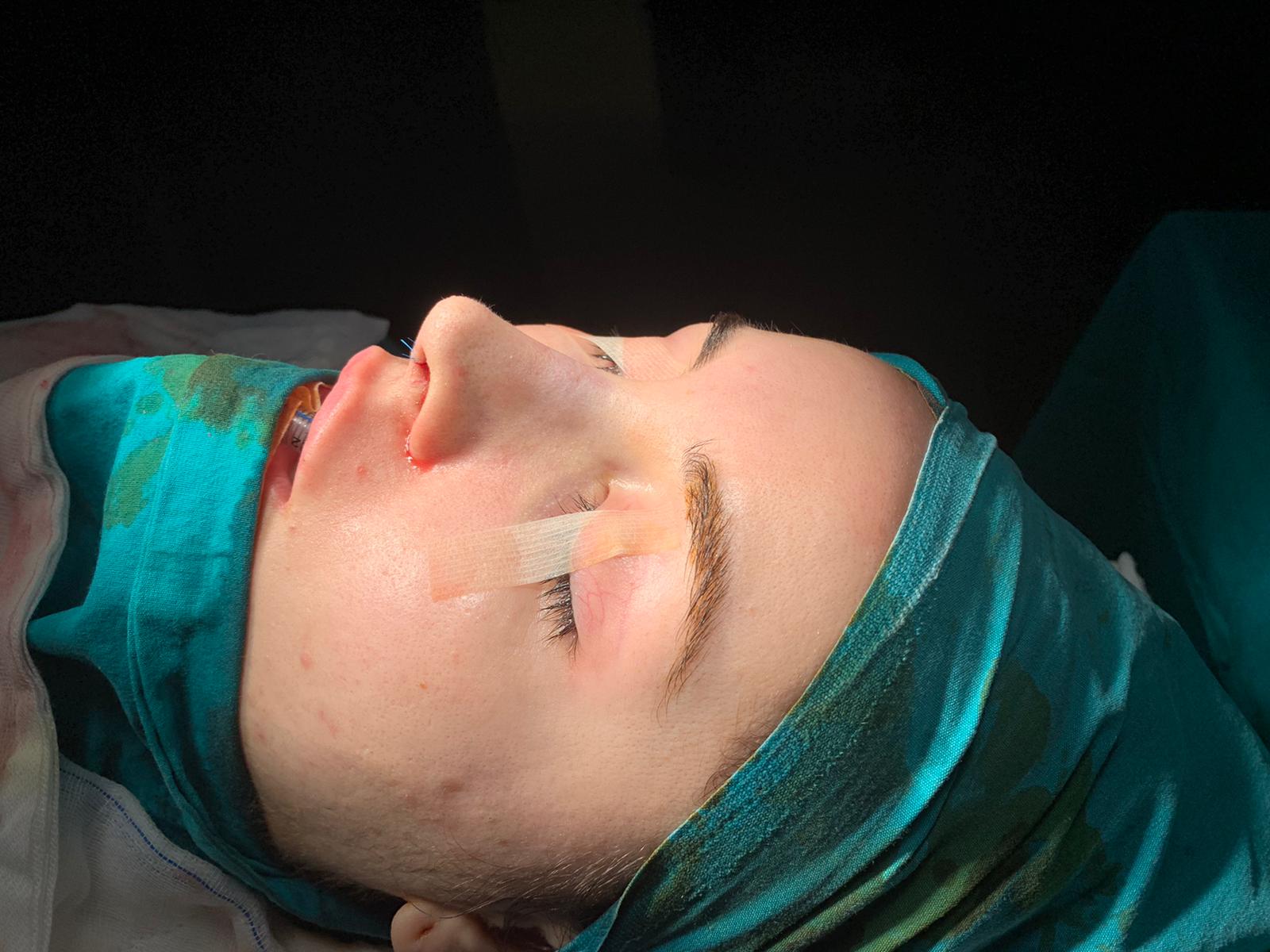 Rhinoplastie avant-aprés