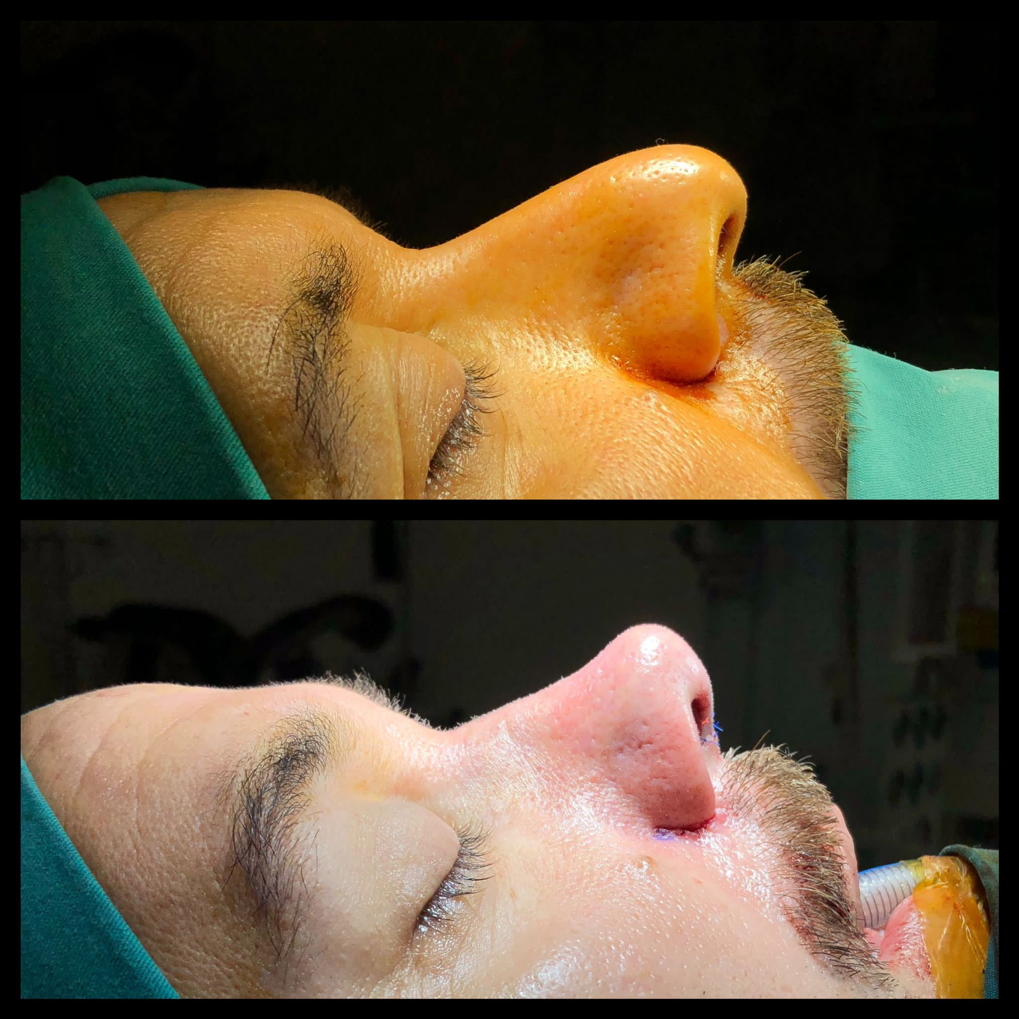 Rhinoplastie avant-aprés