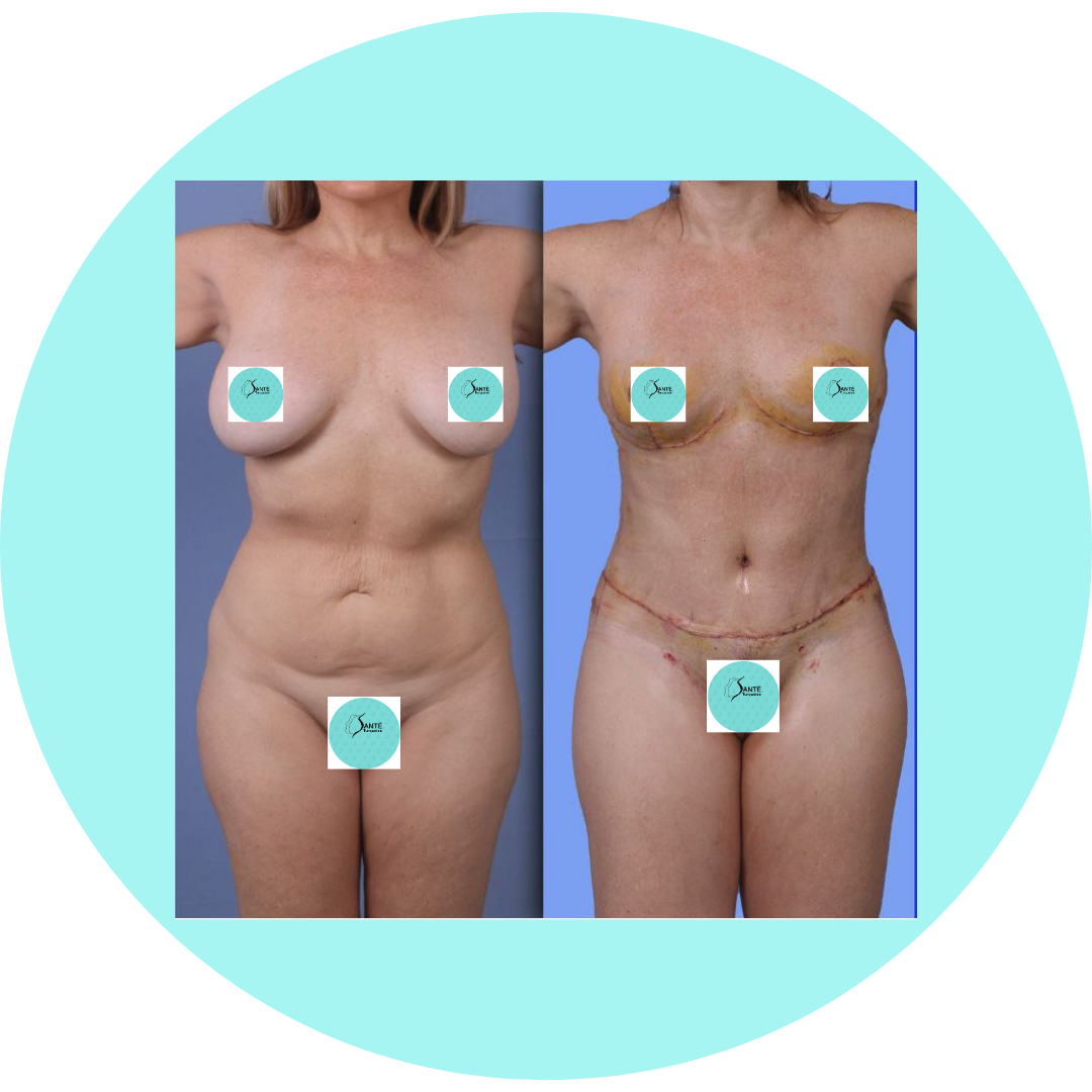 Photo résultat avant-après Mommy Makeover – confiance retrouvée et bien-être physique.