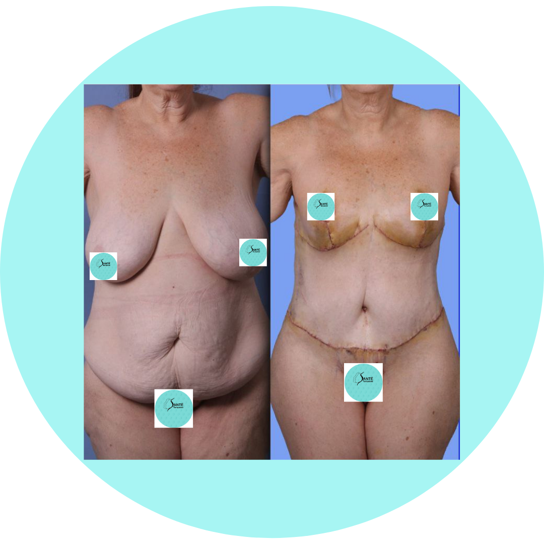Avant / Après Mommy Makeover : retrouver confiance et harmonie du corps après la maternité.