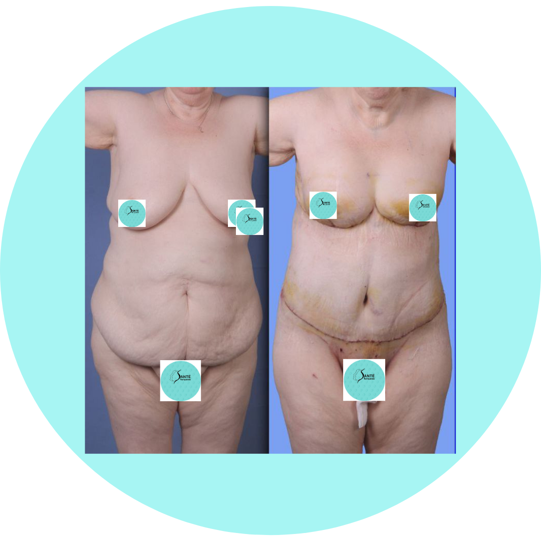 Transformation Mommy Makeover à Istanbul : silhouette tonifiée après chirurgie post-grossesse.