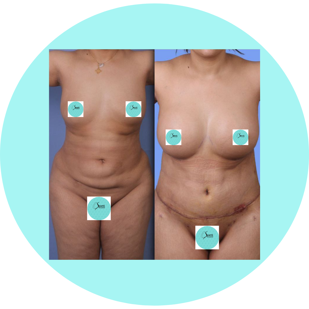 Clinique Turkuaz Istanbul : expertise en Mommy Makeover pour les femmes francophones.
