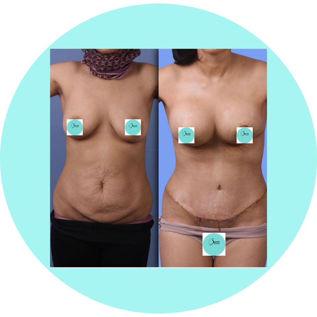 Combinaison liposuccion + abdominoplastie : retrouver un corps sculpté.