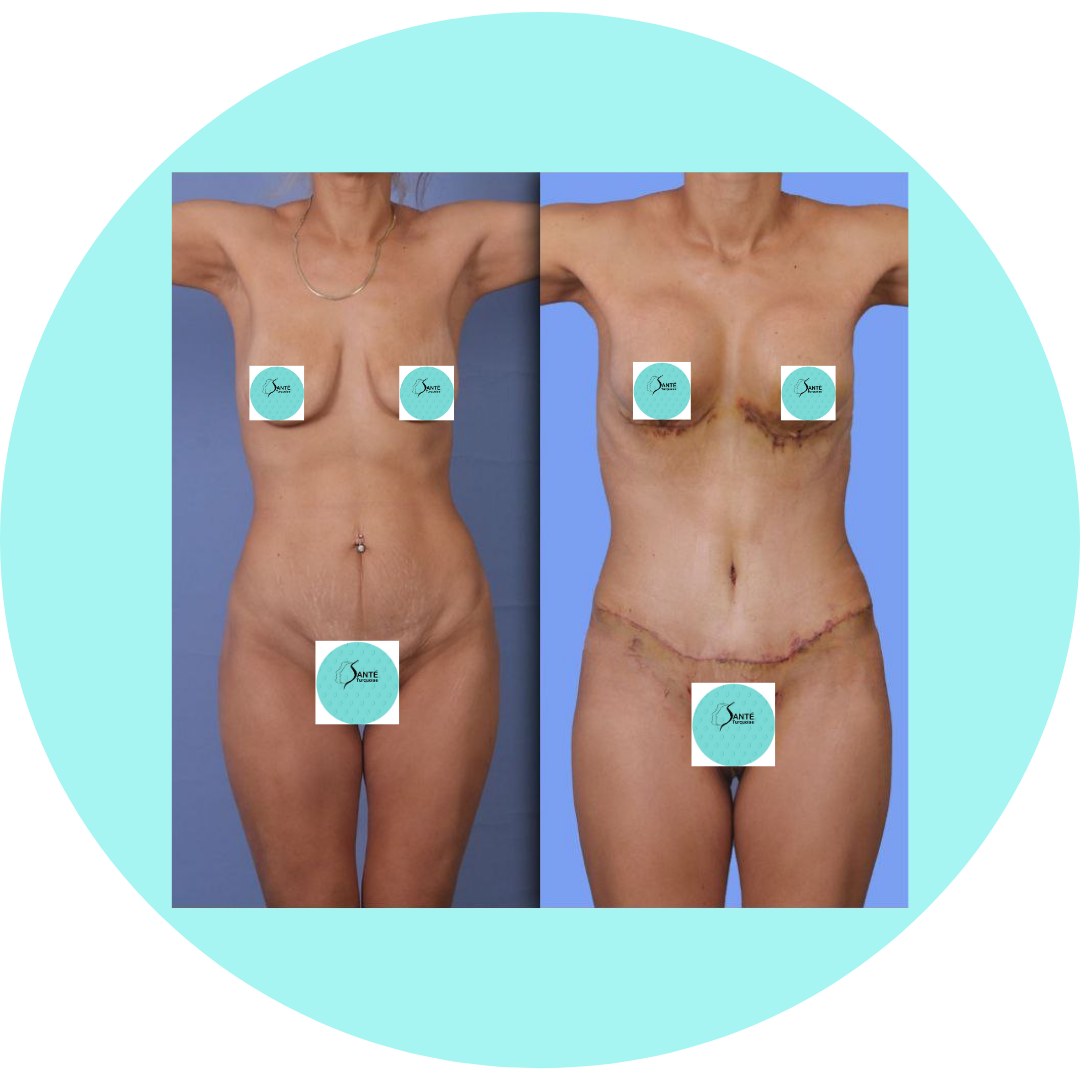 Résultats personnalisés Mommy Makeover Turquie : silhouette affinée et naturelle.