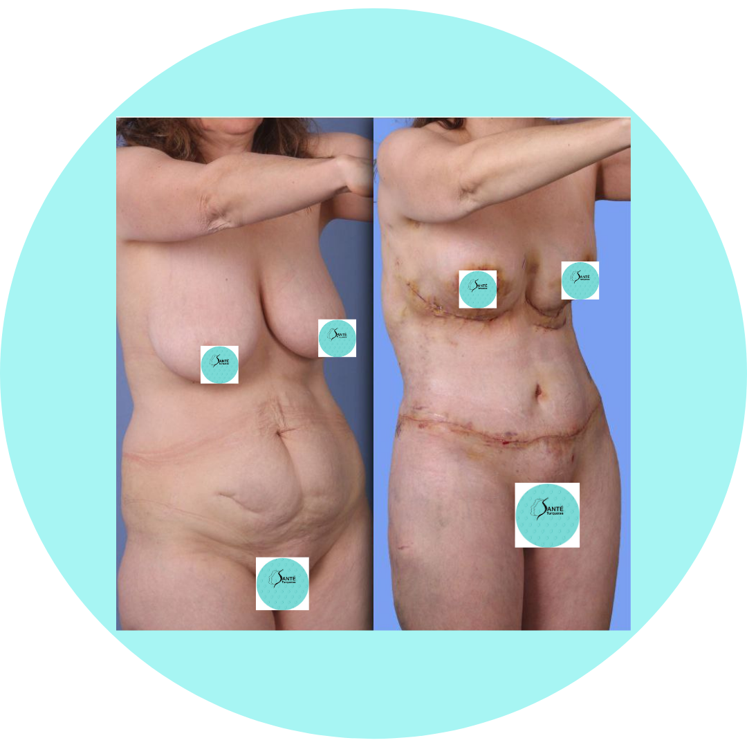 Transformation féminine après accouchement : chirurgie esthétique globale.