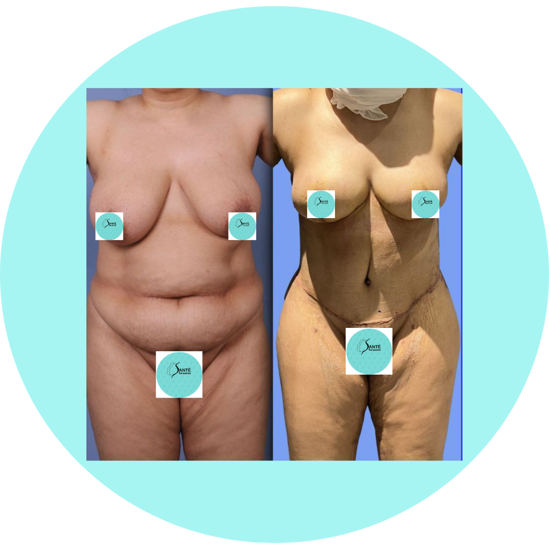 Redéfinition du ventre et de la poitrine après grossesse – Mommy Makeover complet.