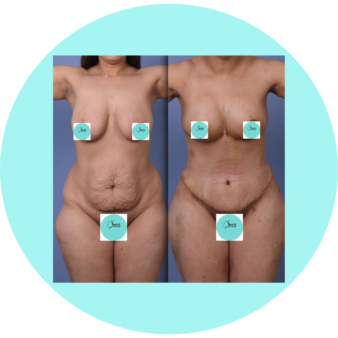 Chirurgie esthétique post-partum à Istanbul avec Turkuaz Clinic.