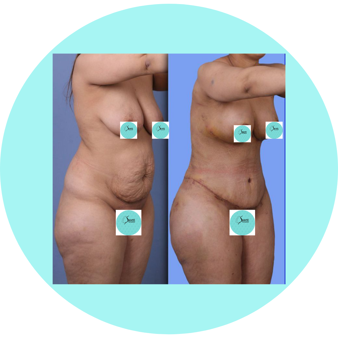 Résultats naturels d’une abdominoplastie et d’un lifting mammaire combinés.