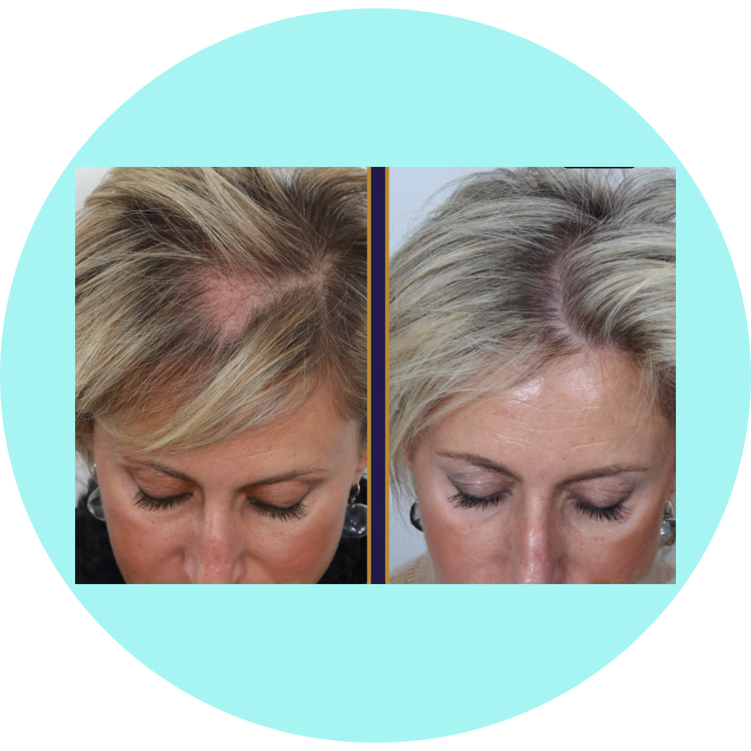 Greffe de cheveux femme 2