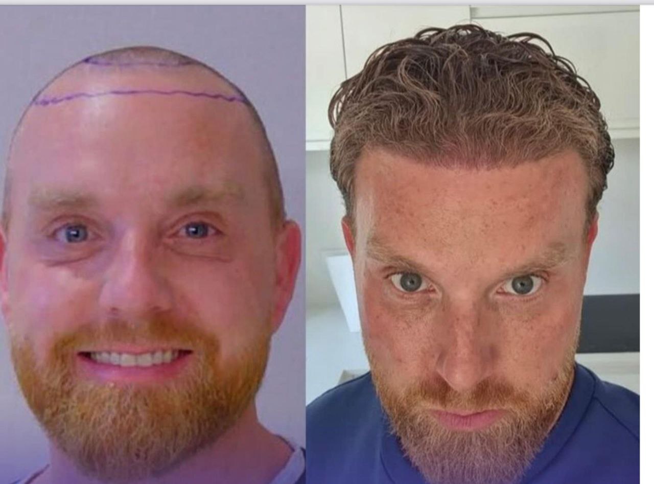 Reconstruction de la ligne frontale par greffe DHI : comparaison avant-après avec implantation naturelle des cheveux