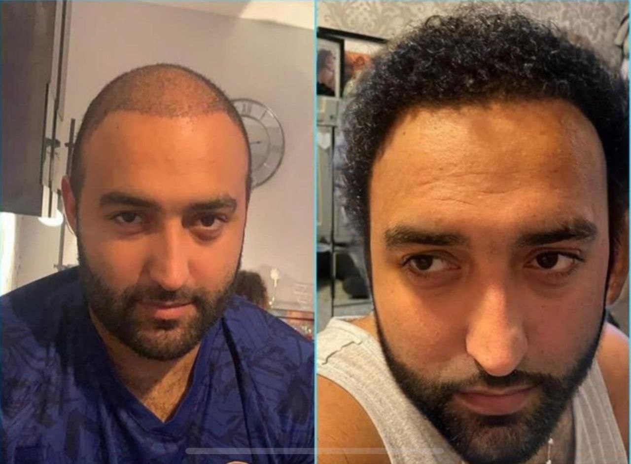 Avant-après greffe de cheveux DHI à Istanbul : résultat naturel et dense après 12 mois, patient francophone
