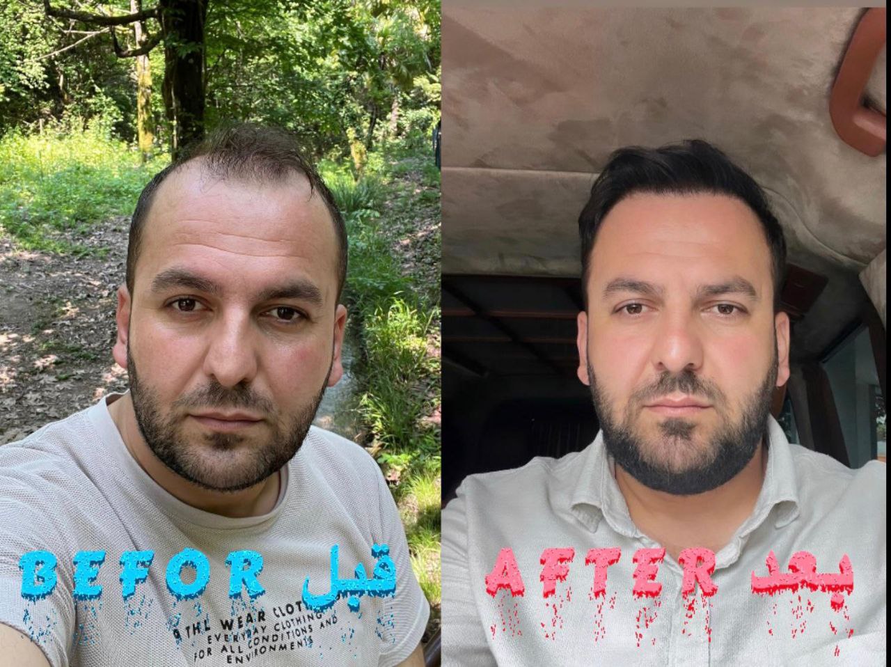 Homme jeune avant et après greffe DHI des golfes temporaux : correction de la calvitie précoce sans rasage complet