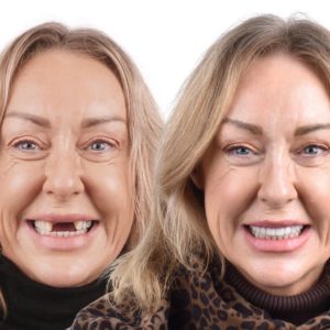 6 implants 24 couronnes en zircone Italie Patient janvier 2026
