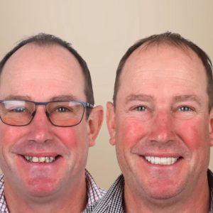 6 implants + 24 couronnes en zircone Patient britannique 52 ans janvier 2026