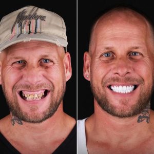 8 implants 24 couronnes en zircone Allemagne Patient Janvier 2026