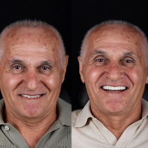 8 implants 24 couronnes en zircone Roumanie Patient 66 Âge Février 2026