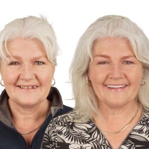 8 implants 24 couronnes en zircone Uk Patient 67 Âge février 2026