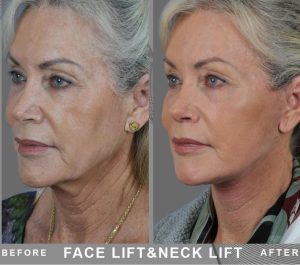 Patient 65 Age Suéde Face Lift + Neck Lift