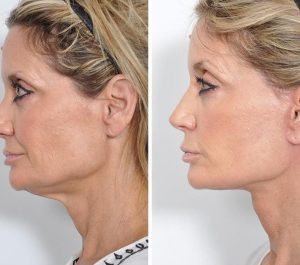 Patiente 56 Age Netherland Double Chin