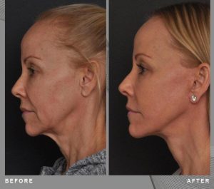 Patiente 56 age Austria Face Lifting