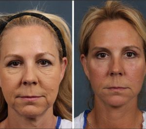 Patiente 57 Age Germany Face Lifting