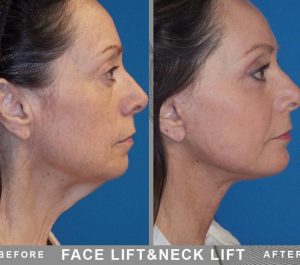Patiente 64 age Finland Face & Neck Lift