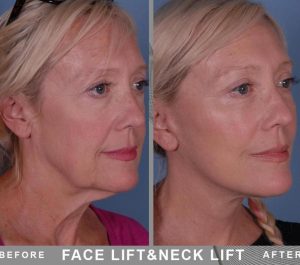 Patiente 64 age Finland Face & Neck Lift