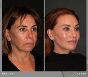 Patiente 60 Age Russia Face lifting