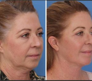 Patiente 62 Ans Switzerland Face Lifting