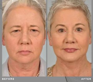 Patiente 63 Age Danemark Face & Neck lift