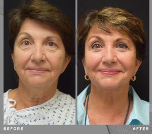 Patiente 64 Age Belgique Face Lifting