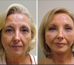 Patiente 64 Age France Face & Neck Lifting