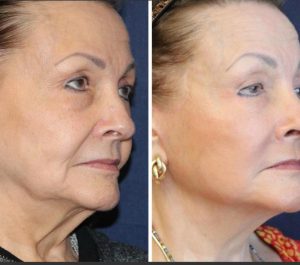 Patiente 65 Age Ukraine Face & Neck Lifting